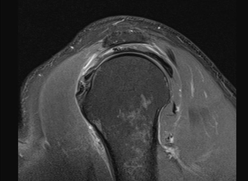 Figure 5 for case Massive interstitial delamination of Supraspinatus with retraction